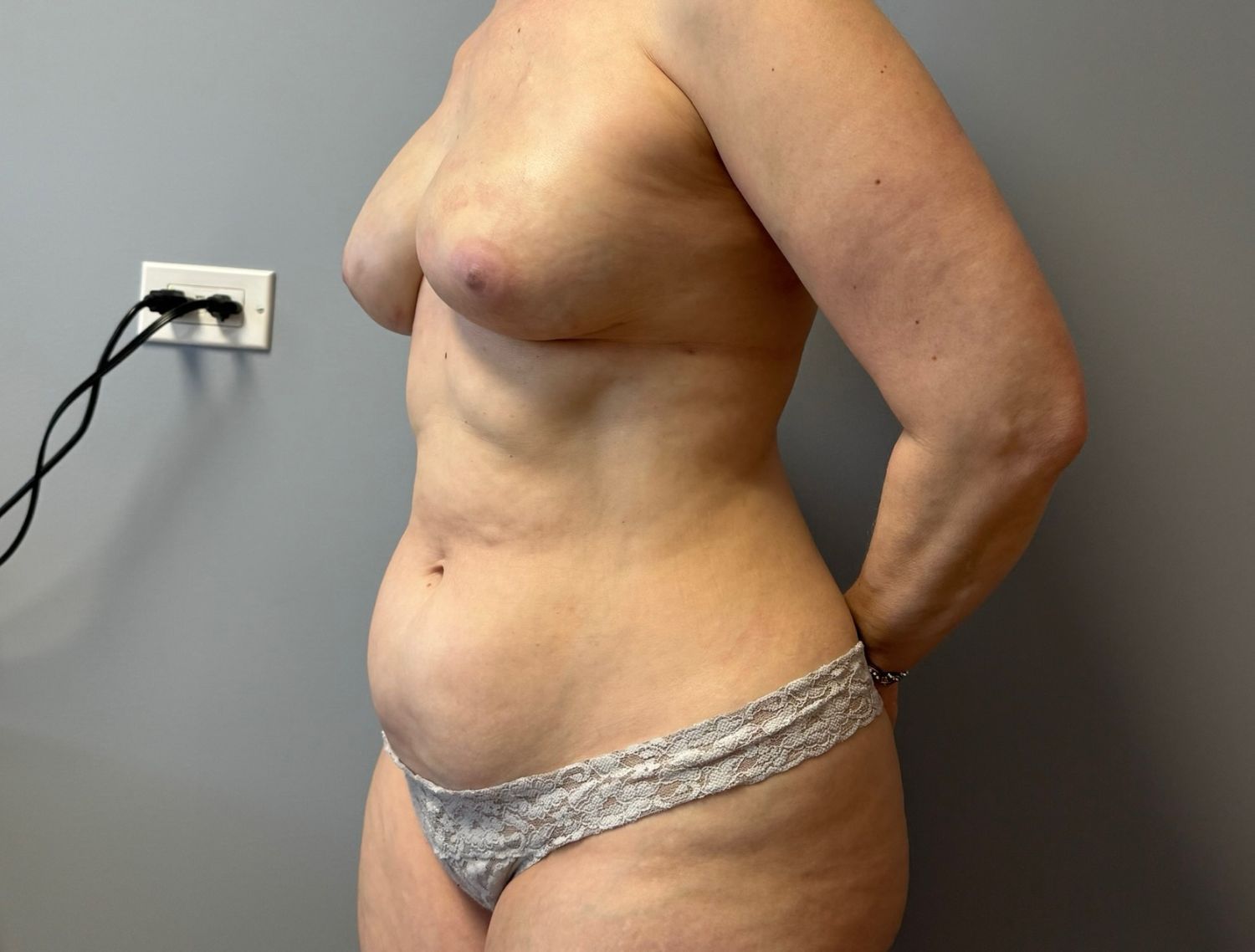 Breast Reconstruction Before & After