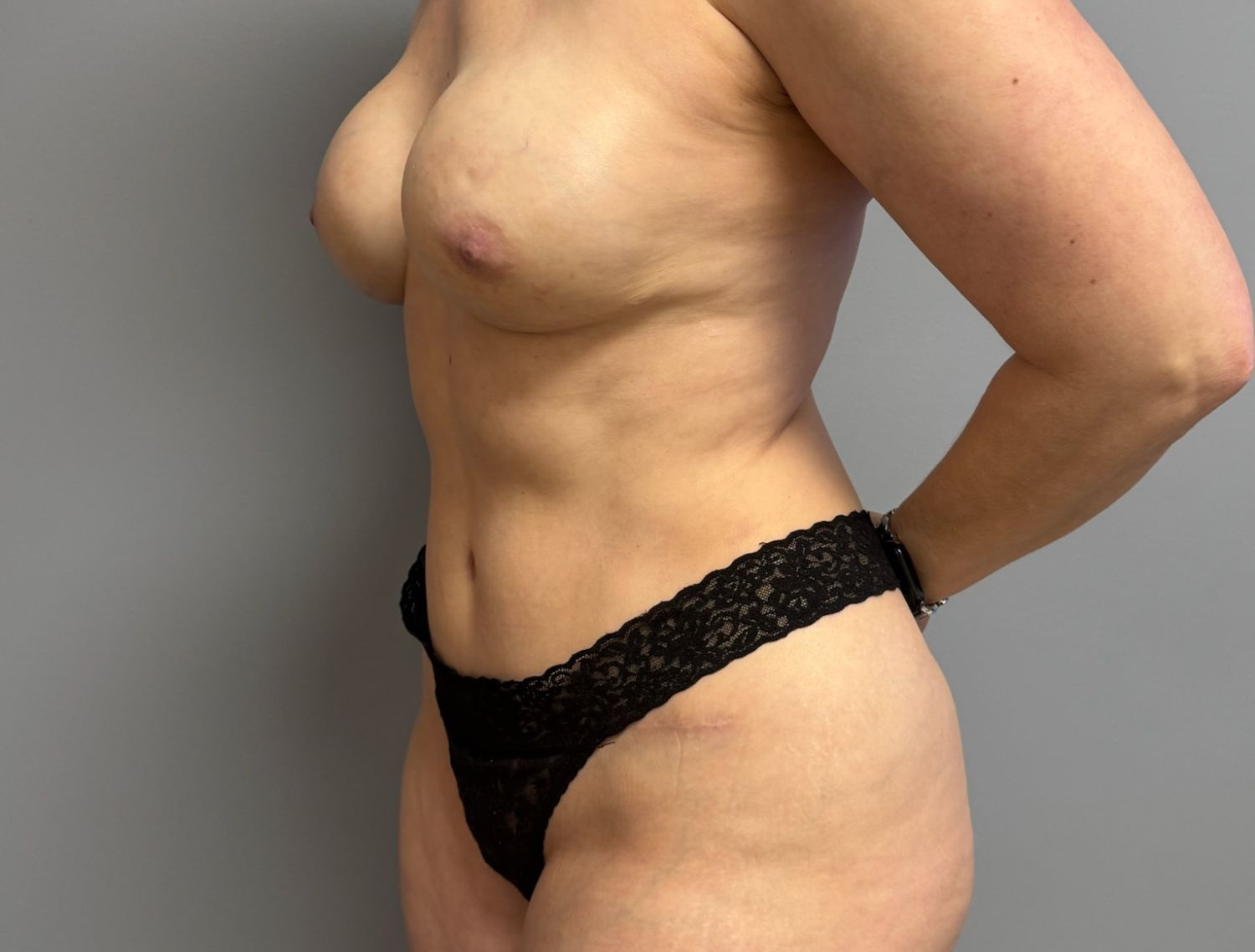 Breast Reconstruction Before & After