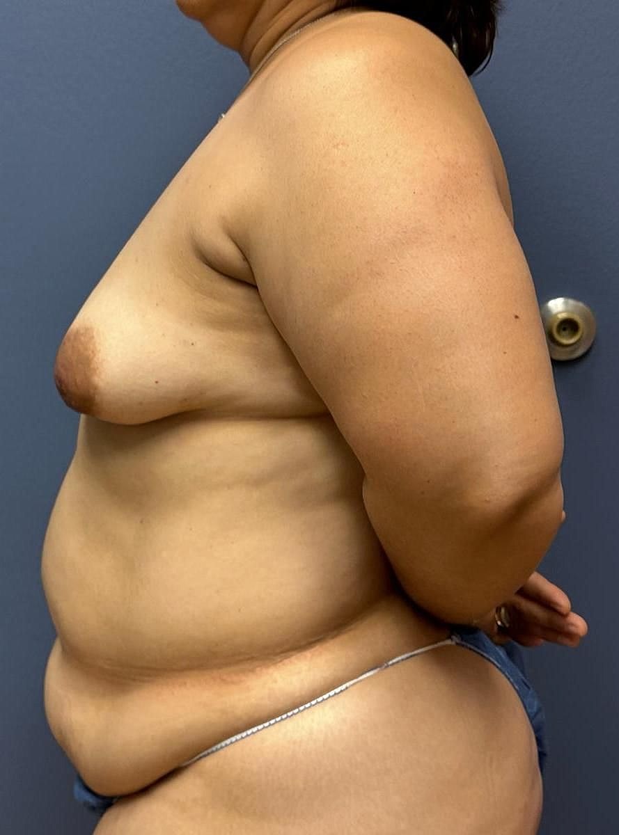 Mommy Makeover Before & After