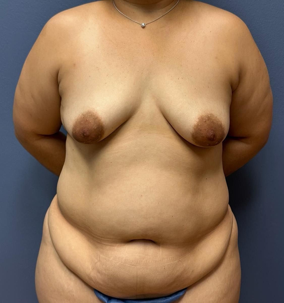 Mommy Makeover Before & After