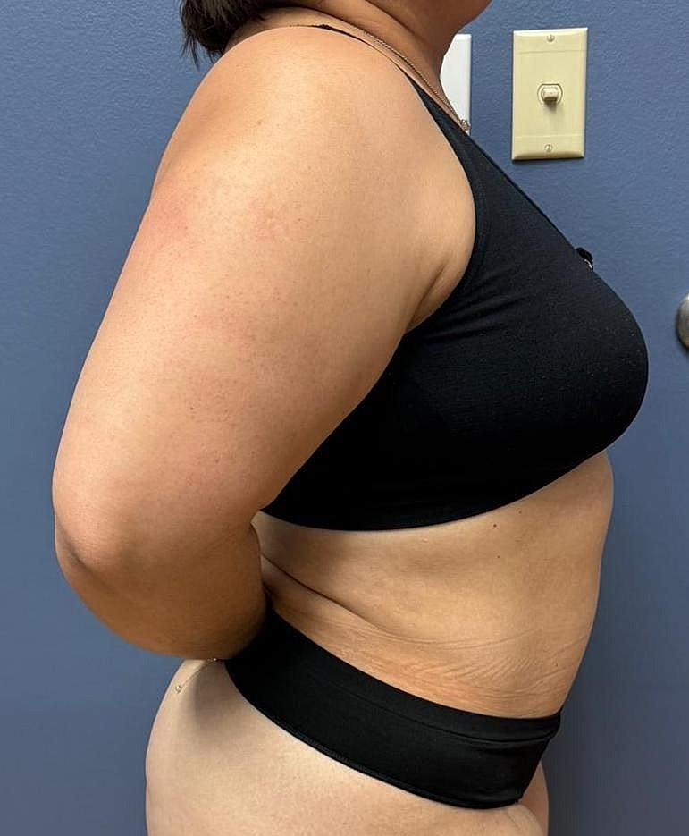 Mommy Makeover Before & After