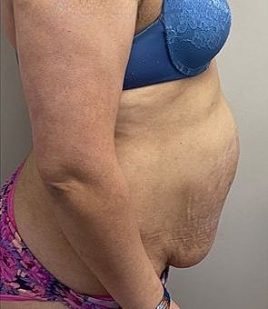 Mommy Makeover Before & After