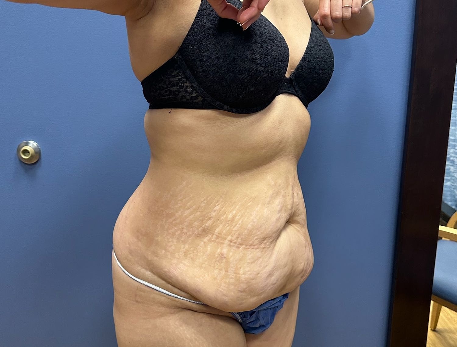 Mommy Makeover Before & After