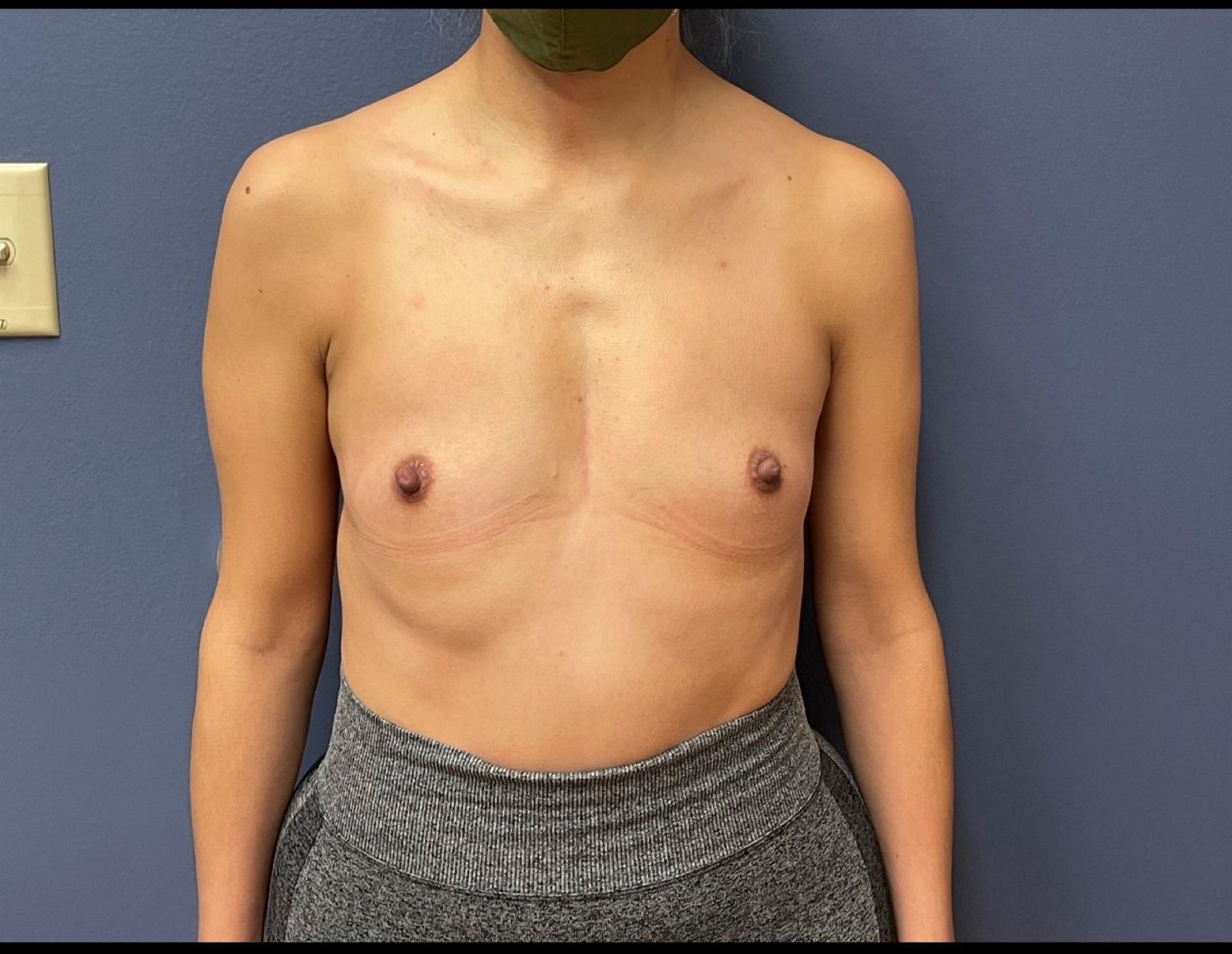 Breast Augmentation Before & After