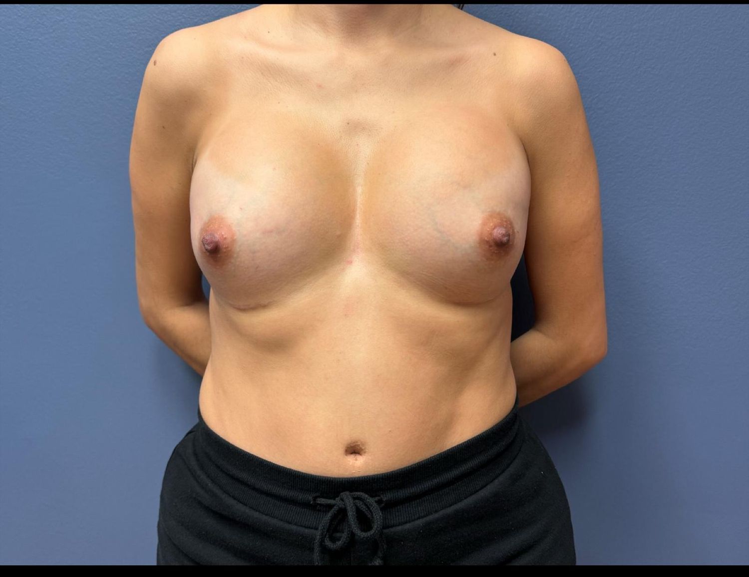 Breast Augmentation Before & After
