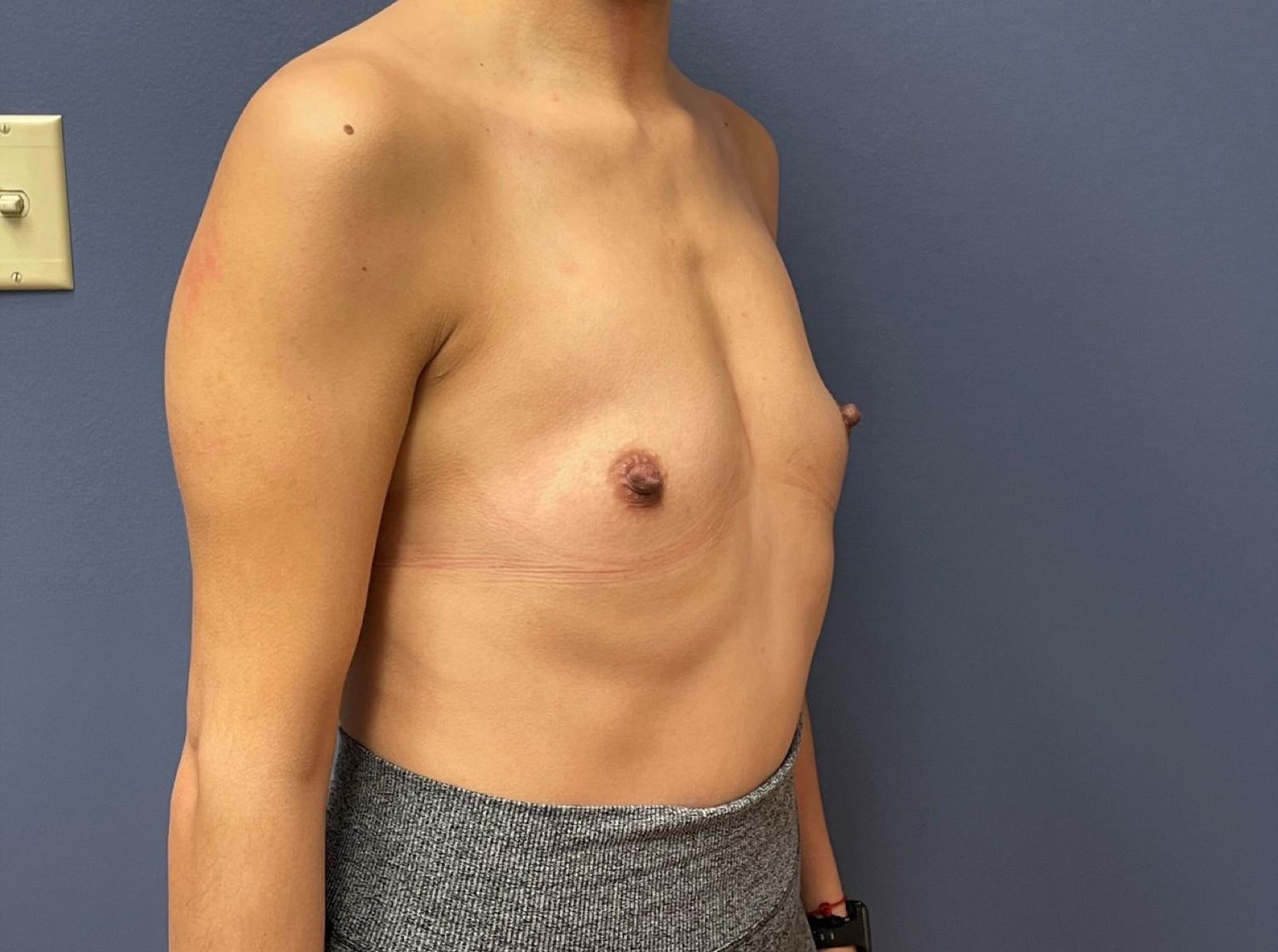 Breast Augmentation Before & After
