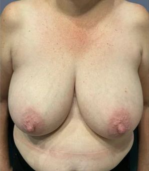 Breast Reduction Before & After