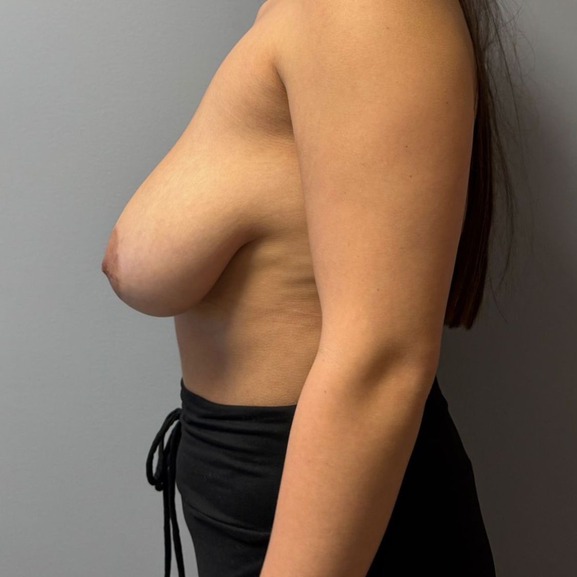 Breast Reduction Before & After