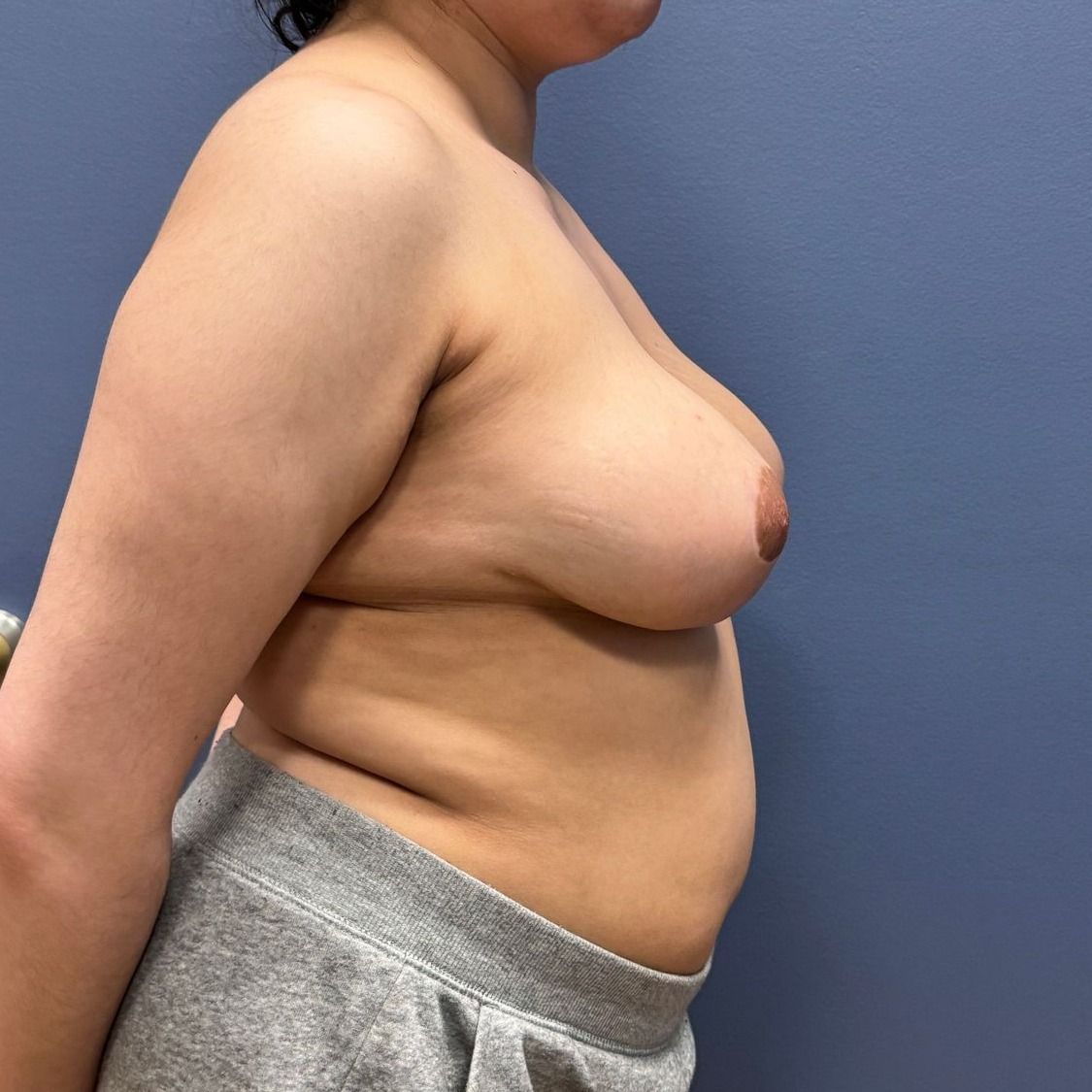 Breast Reduction Before & After