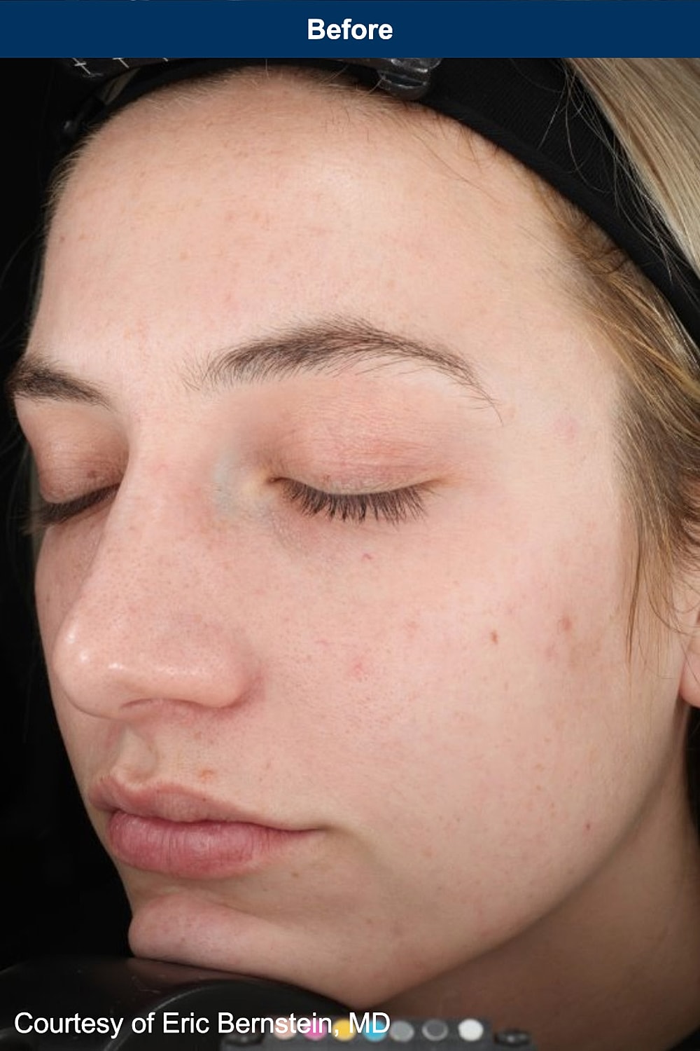 UltraClear Laser Before & After