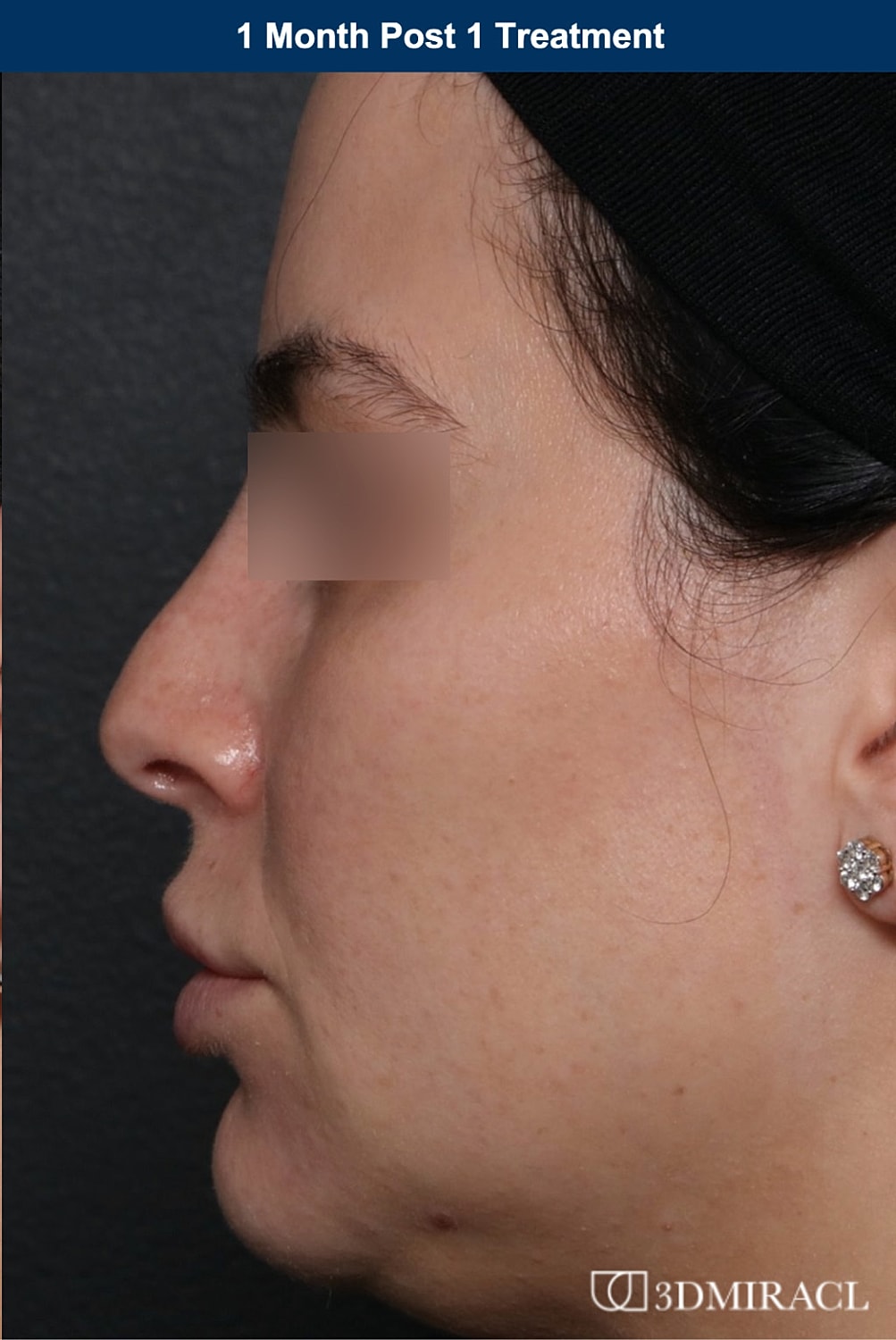 UltraClear Laser Before & After