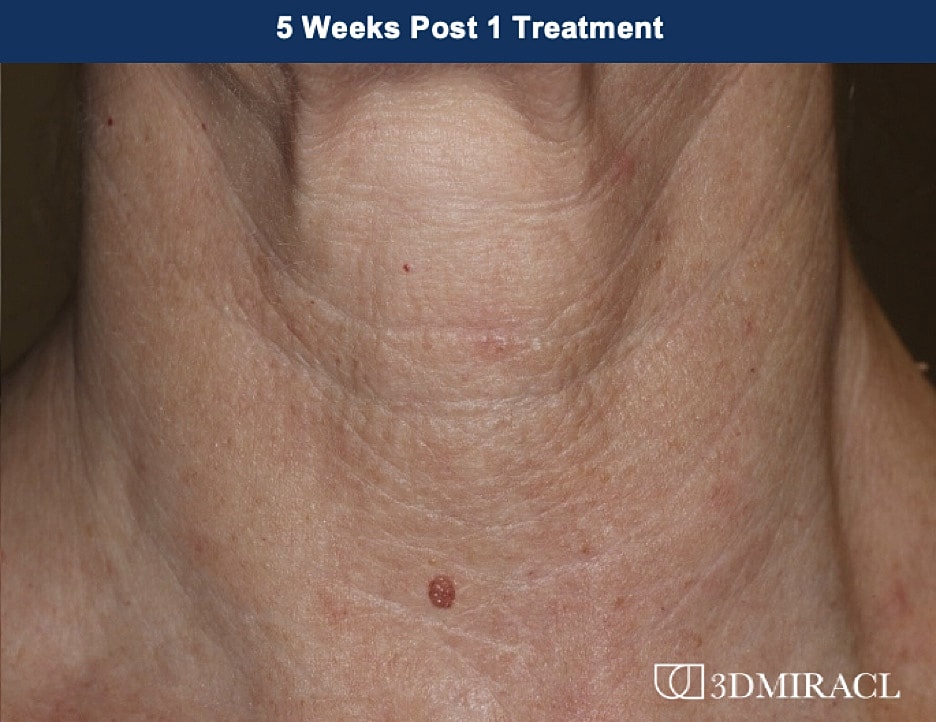 UltraClear Laser Before & After