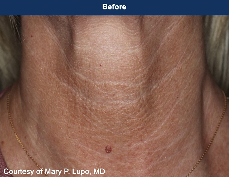 UltraClear Laser Before & After