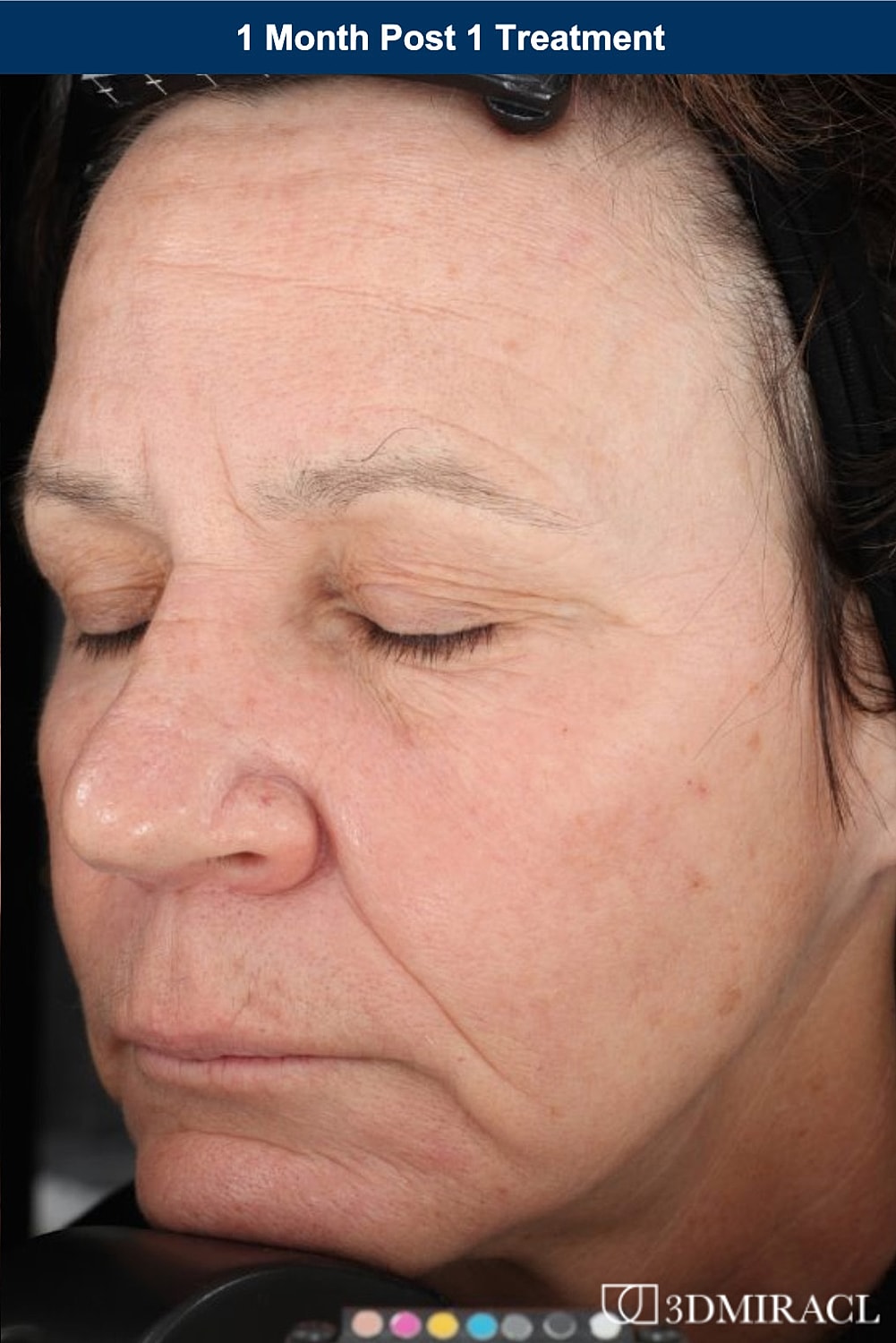 UltraClear Laser Before & After