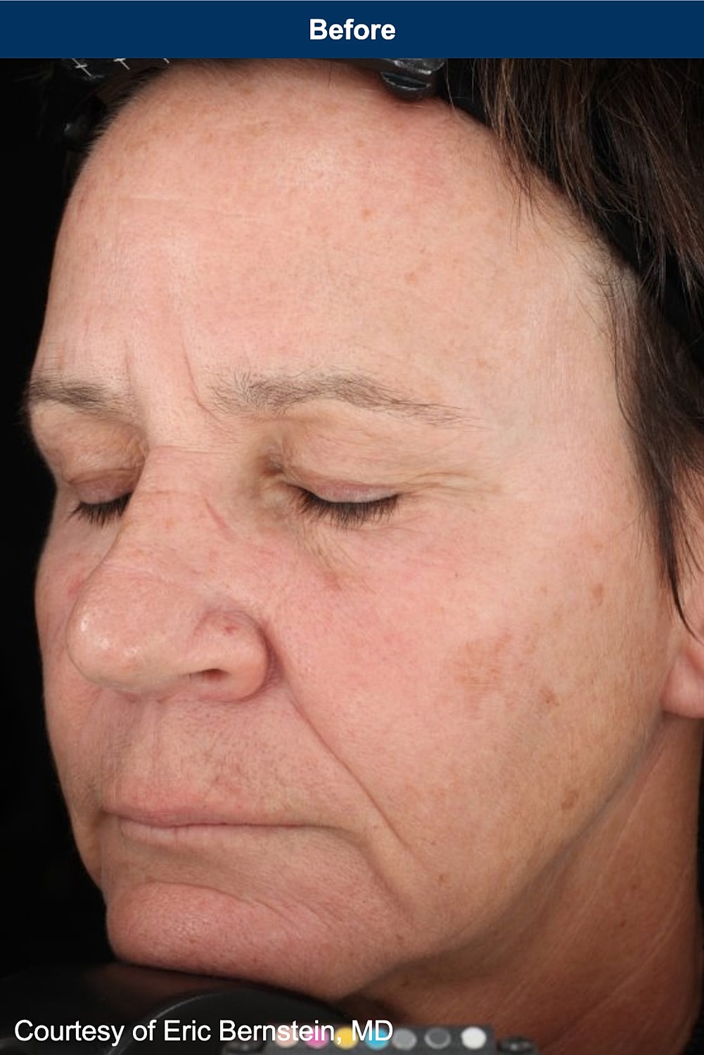 UltraClear Laser Before & After