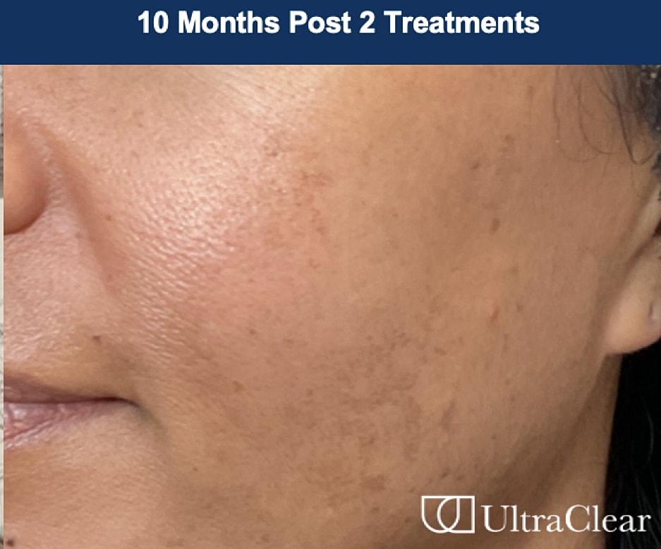 UltraClear Laser Before & After