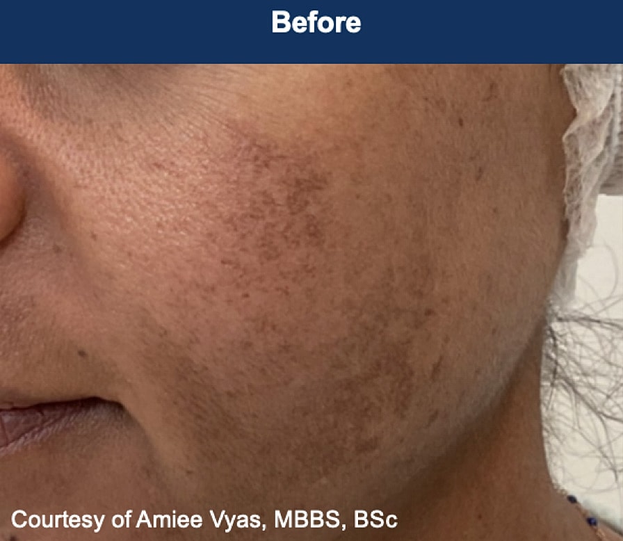 UltraClear Laser Before & After