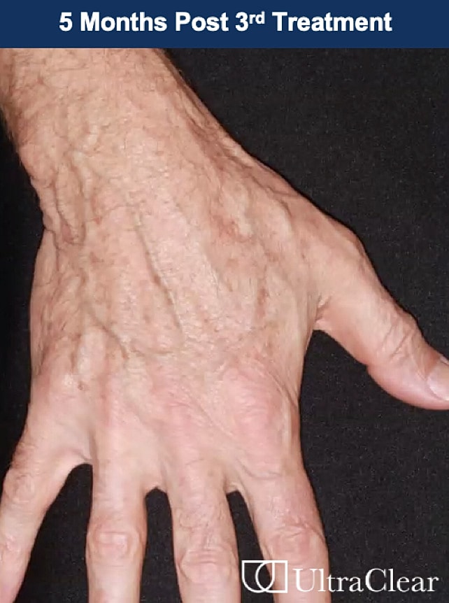 UltraClear Laser Before & After