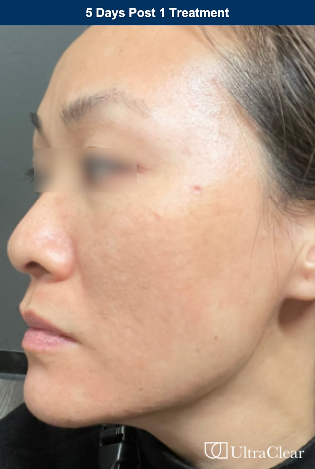 UltraClear Laser Before & After