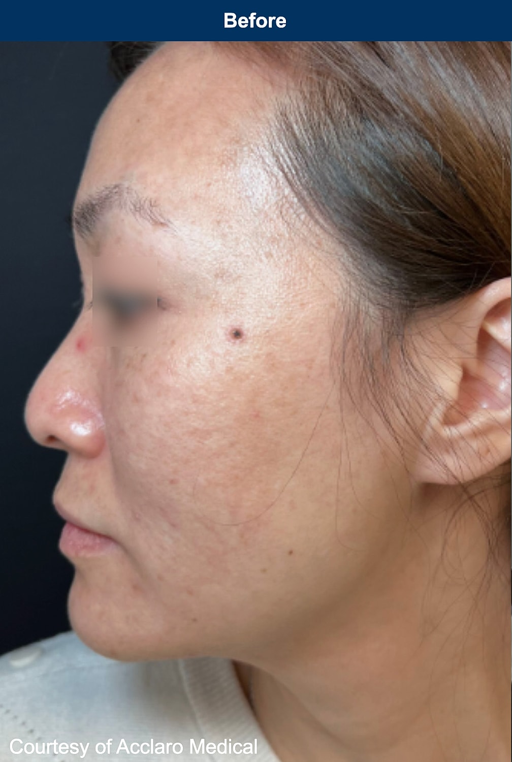 UltraClear Laser Before & After