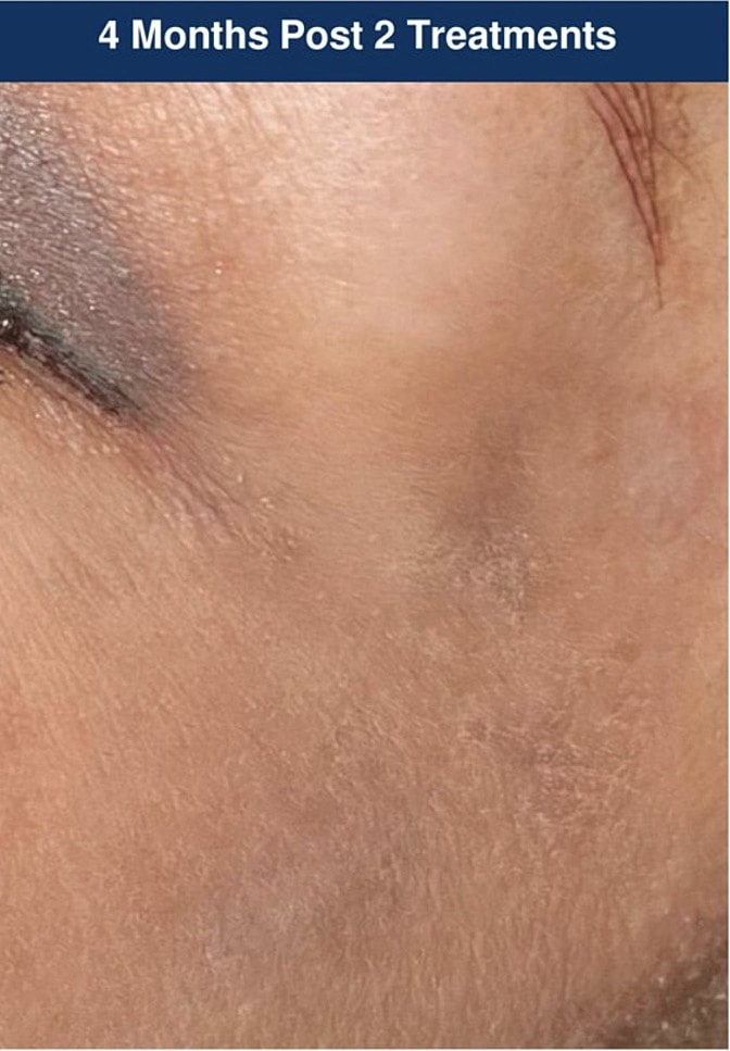 UltraClear Laser Before & After