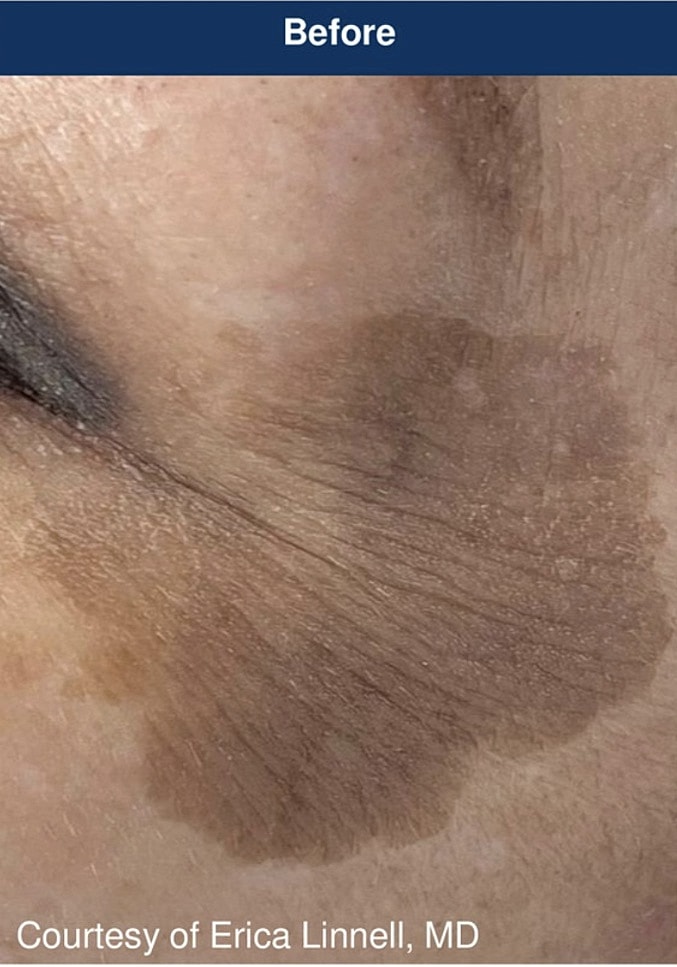 UltraClear Laser Before & After