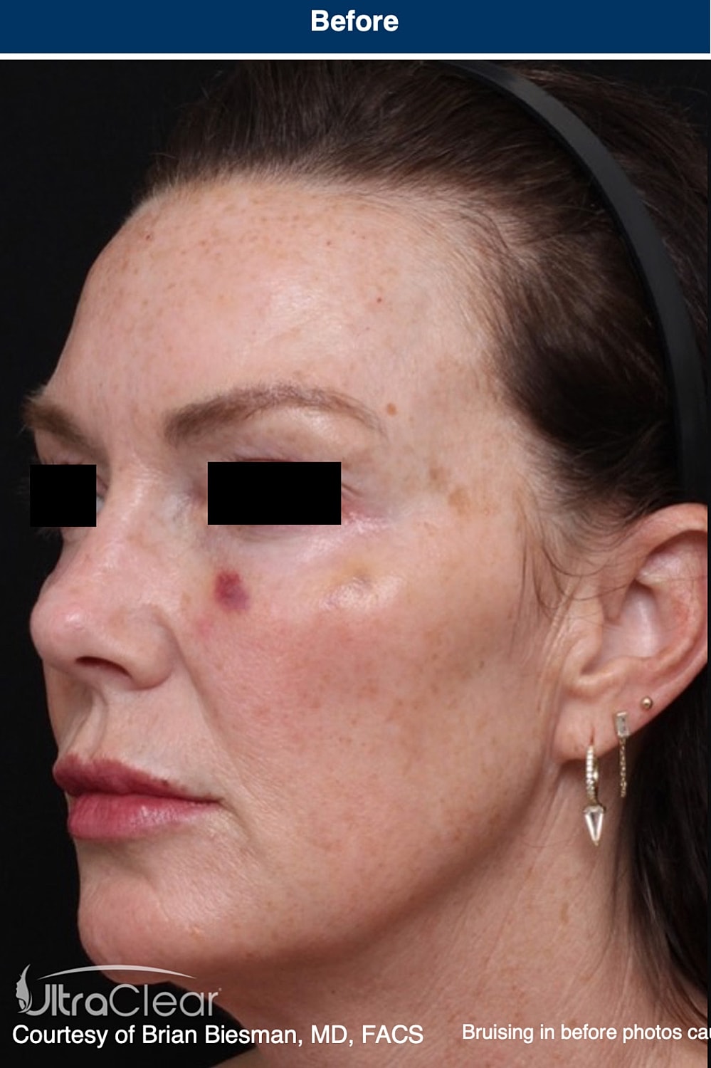 UltraClear Laser Before & After