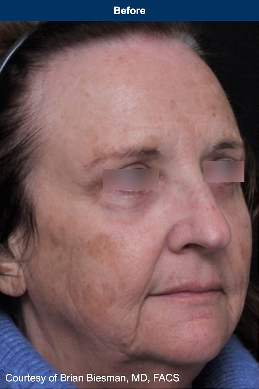 UltraClear Laser Before & After