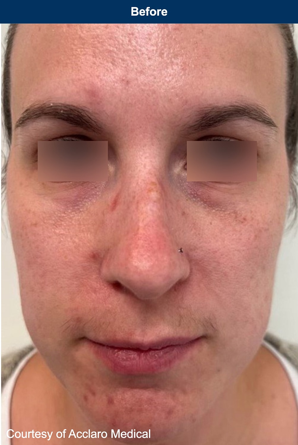 UltraClear Laser Before & After