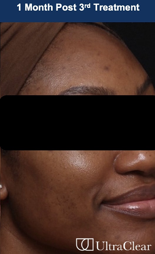UltraClear Laser Before & After