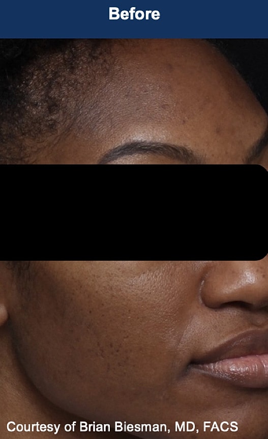 UltraClear Laser Before & After