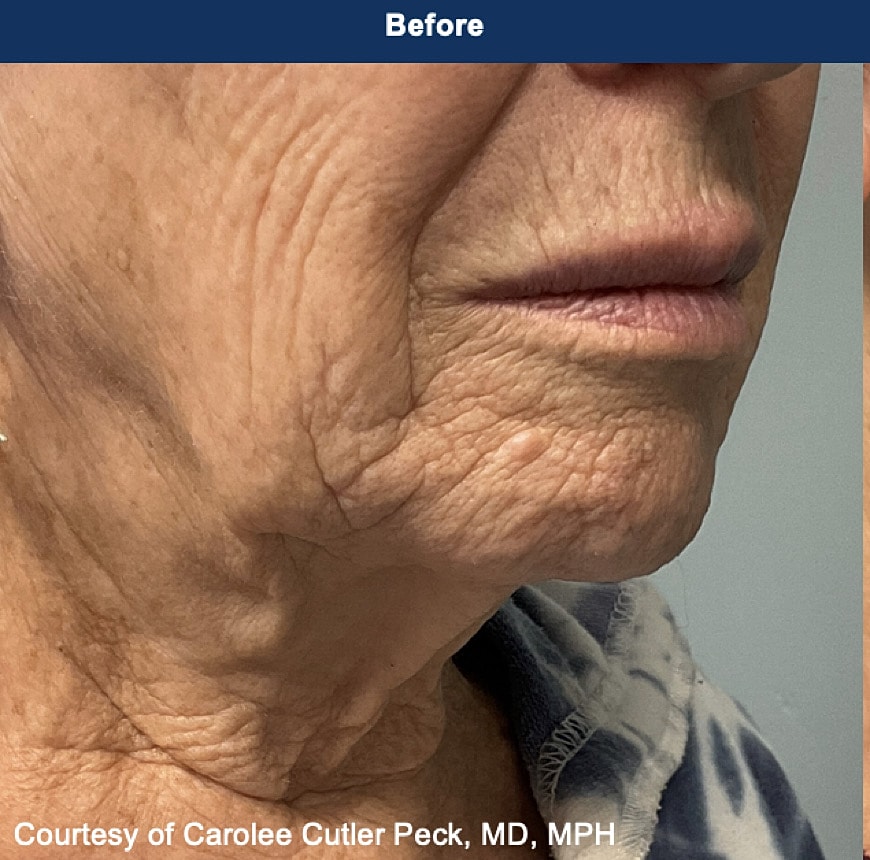 UltraClear Laser Before & After