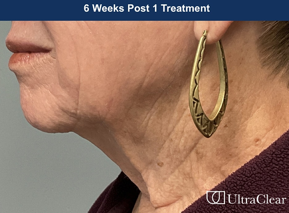 UltraClear Laser Before & After