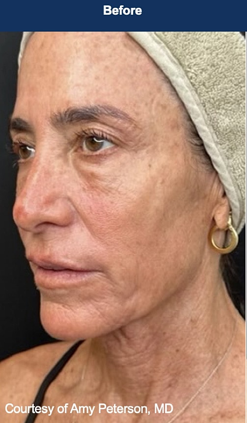 UltraClear Laser Before & After