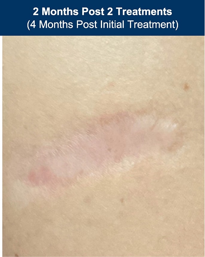 UltraClear Laser Before & After