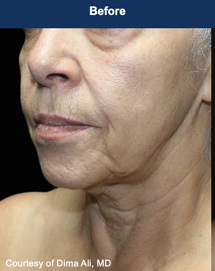 UltraClear Laser Before & After