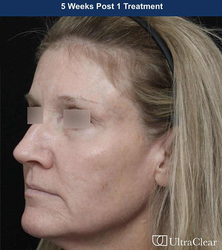 UltraClear Laser Before & After