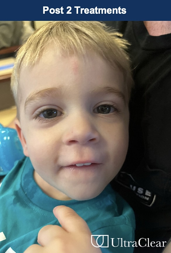 UltraClear Laser Before & After