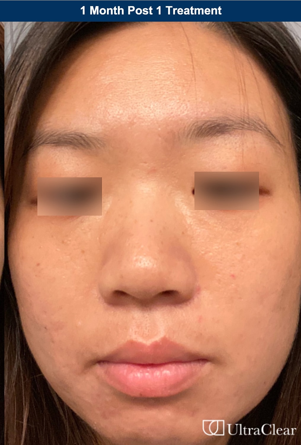 UltraClear Laser Before & After