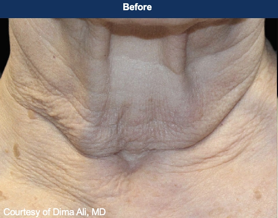 UltraClear Laser Before & After