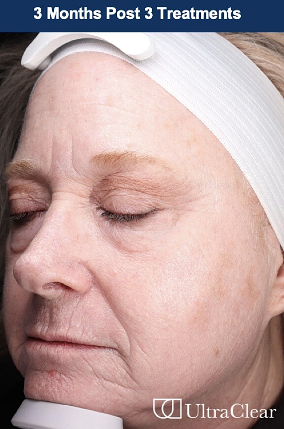 UltraClear Laser Before & After