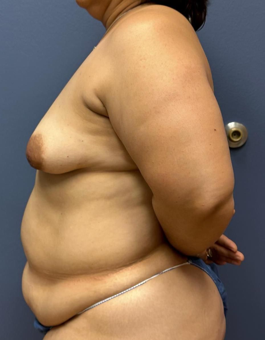 Tummy Tuck Before & After