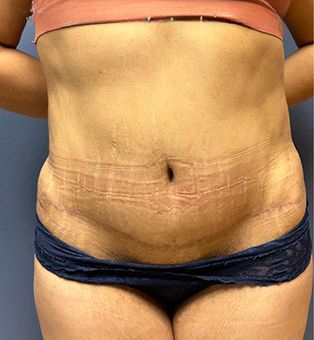 Tummy Tuck Before & After