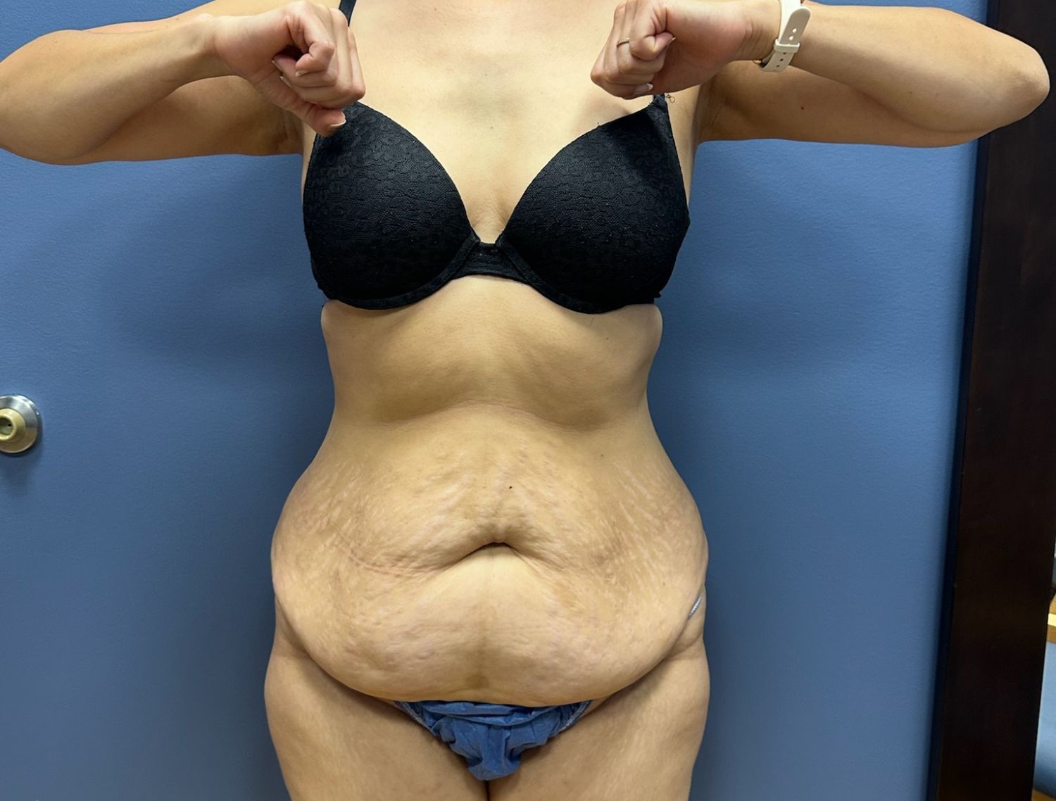 Tummy Tuck Before & After
