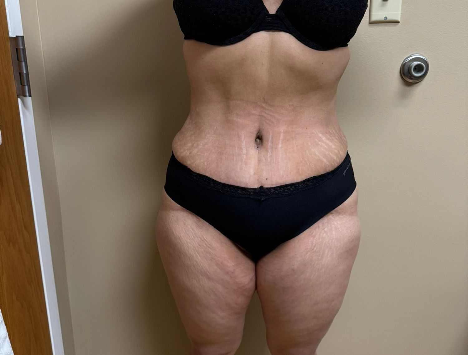 Tummy Tuck Before & After