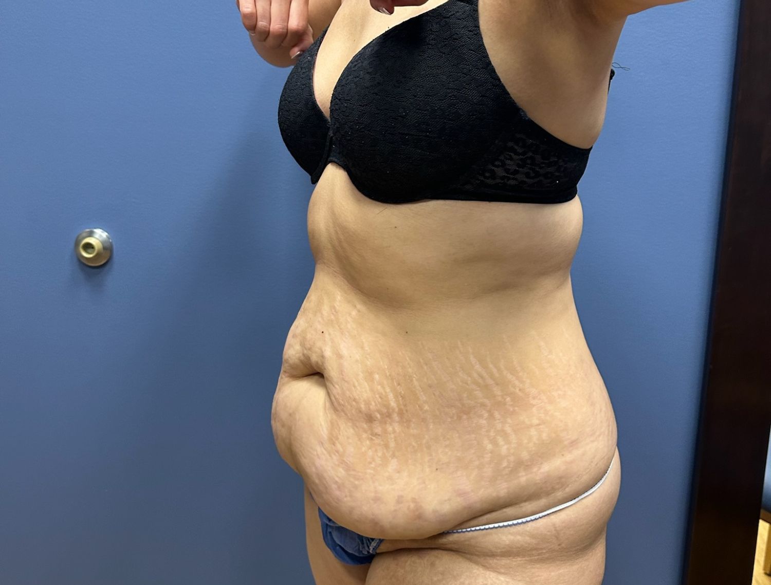 Tummy Tuck Before & After